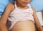 Bocah 5 Tahun di Simalungun Penderita Leukemia Butuh Uluran Tangan Dermawan