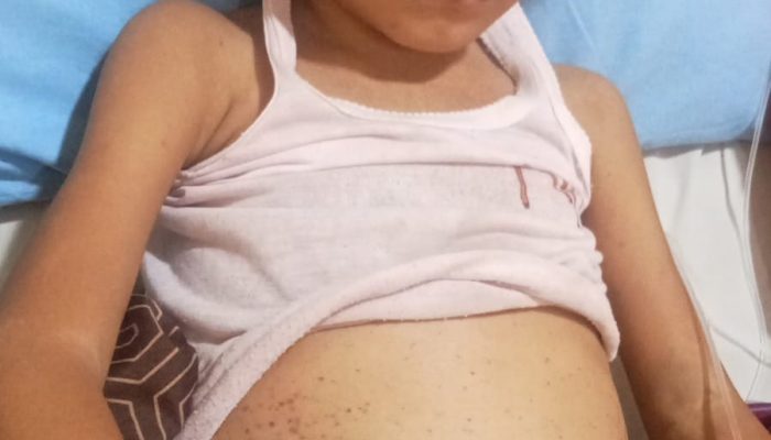 Bocah 5 Tahun di Simalungun Penderita Leukemia Butuh Uluran Tangan Dermawan